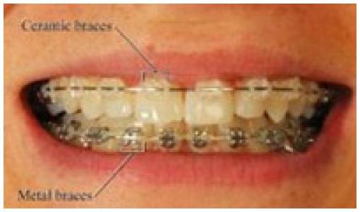 Ceramic Crowns & Bridges
