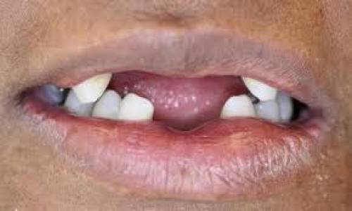 Severely Worn-Out Meeth