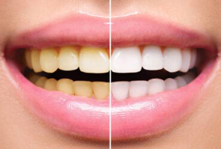 Teeth Whitening