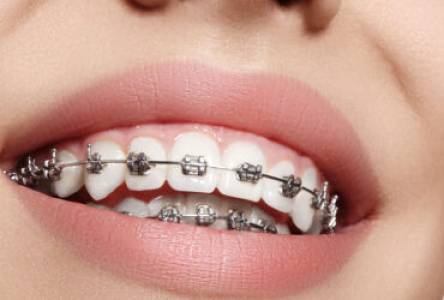 Dental Braces