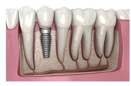 DENTAL IMPLANTS
