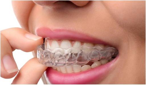 CLEAR ALIGNERS AND DENTAL BRACES