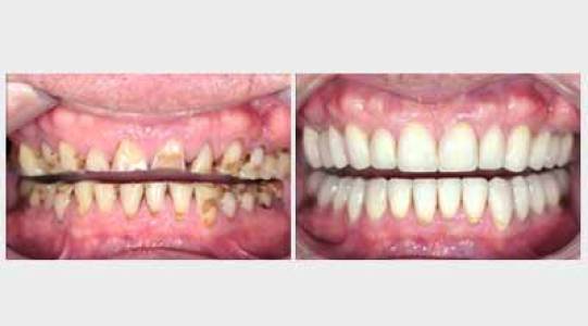 Full Mouth Rehabilitation