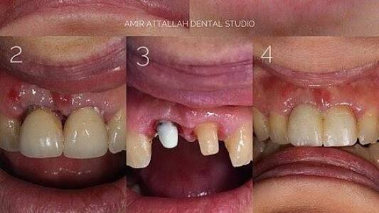 Crown & Bridges treatment