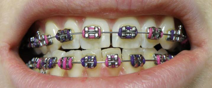 Dental Braces Fixing