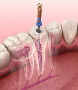 Root Canal Treatment (RCT)