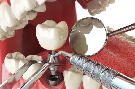 Dental Implants