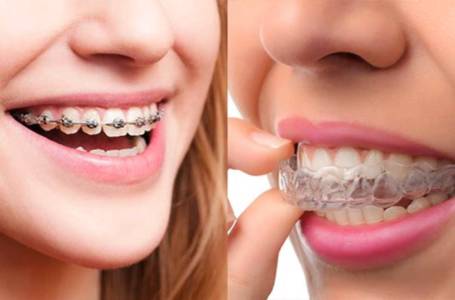 Orthodontic Treatment