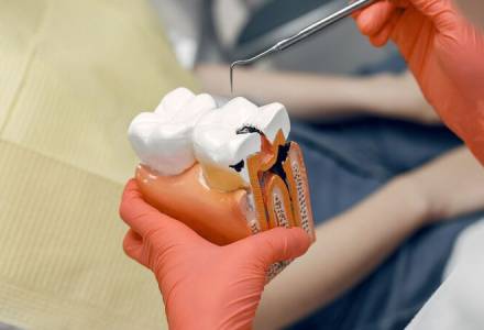Root Canal Treatment