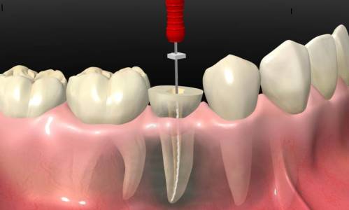 Painless Root Canals