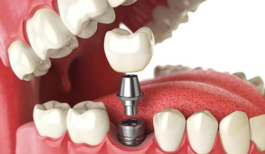 Dental Implants