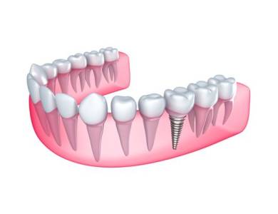 CONVENTIONAL IMPLANTS