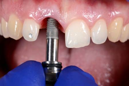 Dental Implant Treatment
