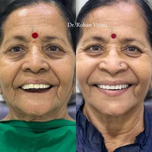 Patient Specific Dental Implants