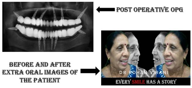TTPHIL Dental Implants