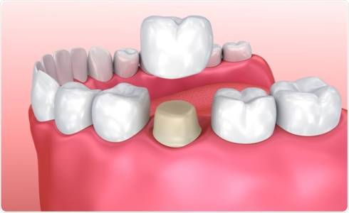 Ceramic & Zirconia Crowns & Bridges