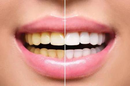 Teeth Cleaning, Scaling, Polishing & Bleaching