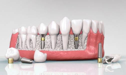 Dental Implants in Andheri West