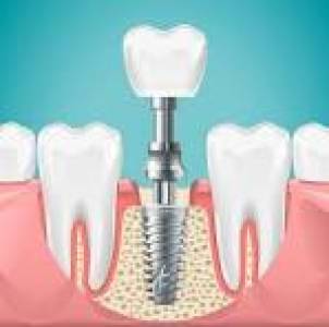 Root Canal Treatment
