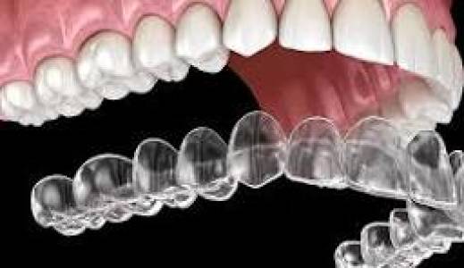 aligners
