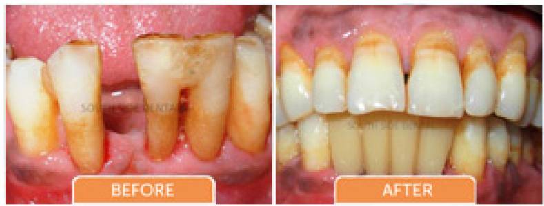 single missing tooth