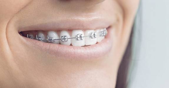 Orthodontic Treatment