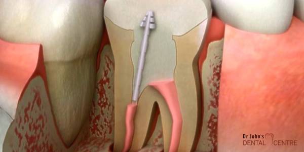 Root Canal