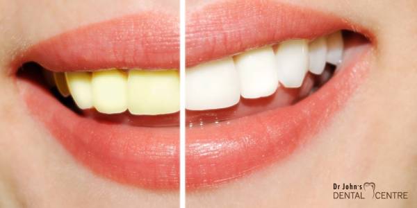 Teeth Whitening