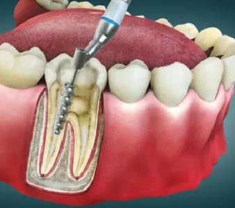 Root Canal Treatment (RCT)