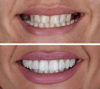 Dental Implants