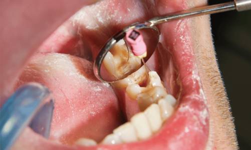 Dental Fillings