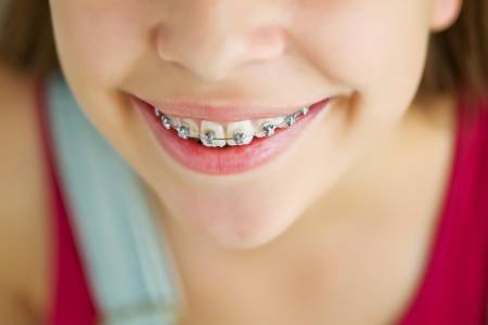 ORTHODONTIA/ BRACES TREATMENT