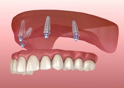 Dental Implant Treatment in Indore