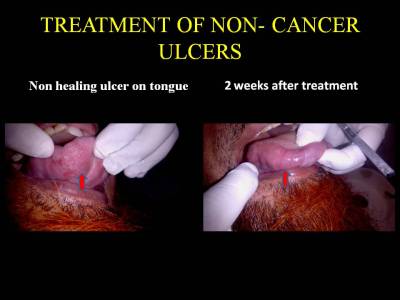 Tobacco-induced Leukoplakia/ Erythroplakia