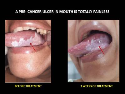 Care of Diabetic Mouth