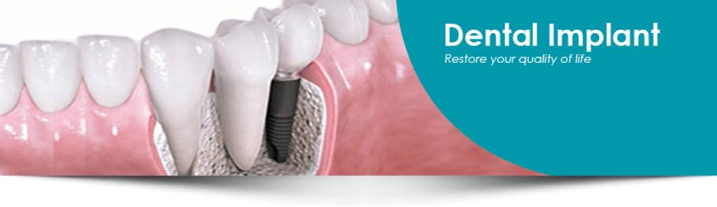 Dental Implant Indore