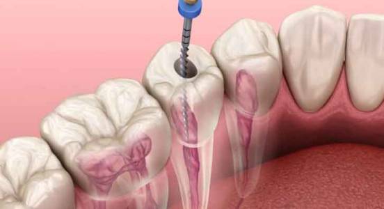 Root Canal Treatment