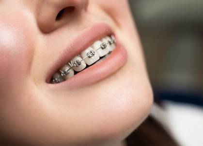 Orthodontics (Braces)