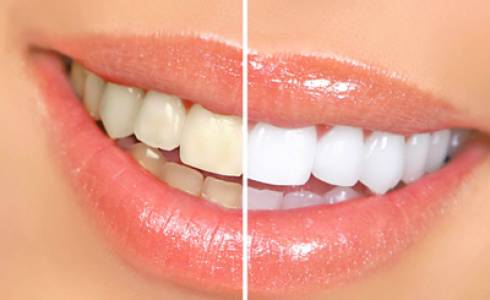 Teeth Whitening