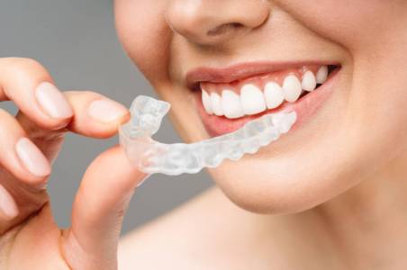 INVISALIGN Aligners