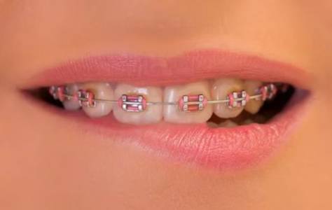Braces