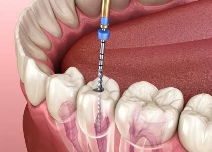Painless Single-Visit Root Canal Treatment