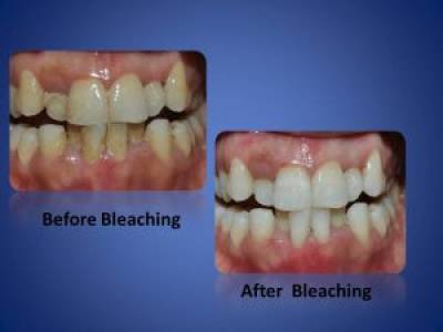 Teeth Whitening