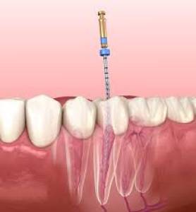 Root Canal Treatment