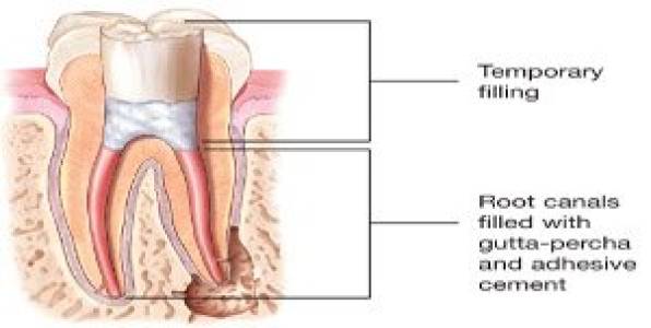 Root Canals