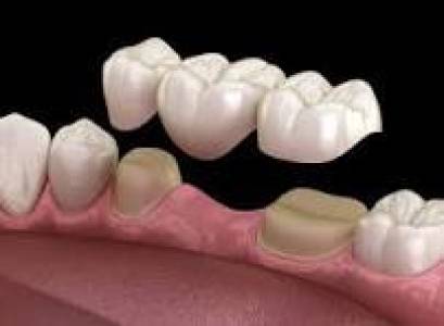 Dental Crowns in Indore