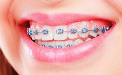 ceramic braces