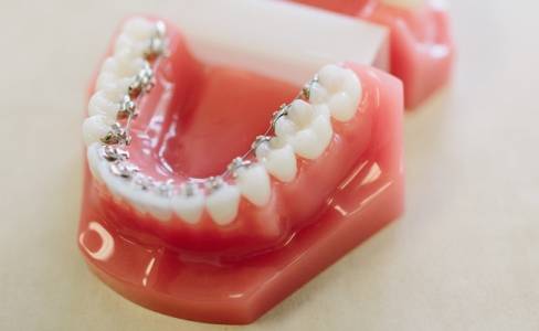 Lingual Orthodontics