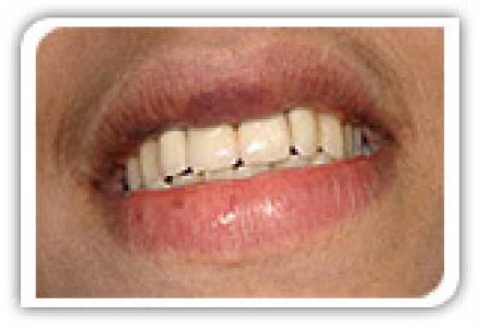 Crowns & Dental Bridges