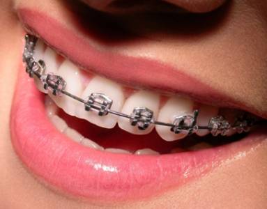 Orthodontic